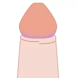 嵌頓包茎について