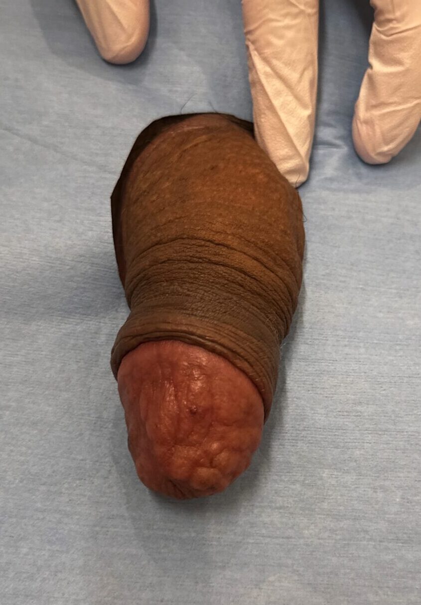 男性器・女性器の永久フィラー注入で起こり得る壊死や変形などのリスクをまとめた医療リスク説明図。