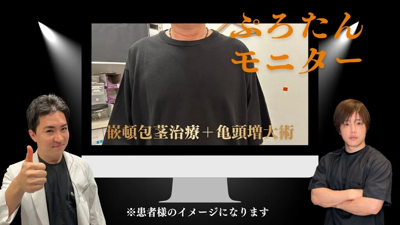 形成外科専門医による嵌頓包茎治療と亀頭増大術の症例写真。狭窄した包皮を改善し、亀頭直下デザイン縫合とヒアルロン酸PRO6cc注入によって自然な仕上がりと力強い亀頭形成を実現した男性器治療例。