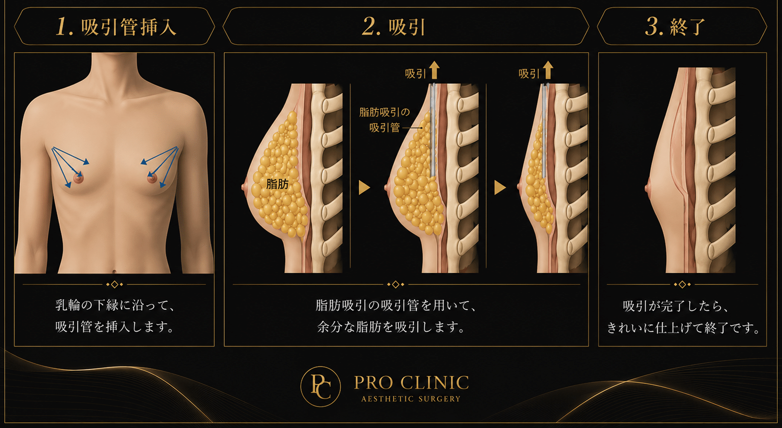 偽性女性化乳房の治療アプローチ 偽性女性化乳房治療を示す図