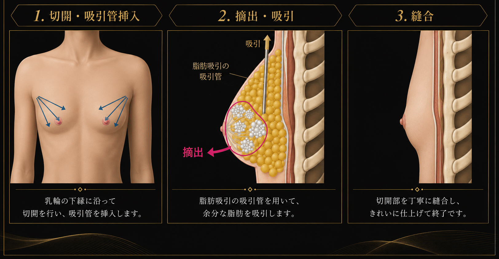 混合性女性化乳房の治療アプローチ 混合性女性化乳房治療を示す図