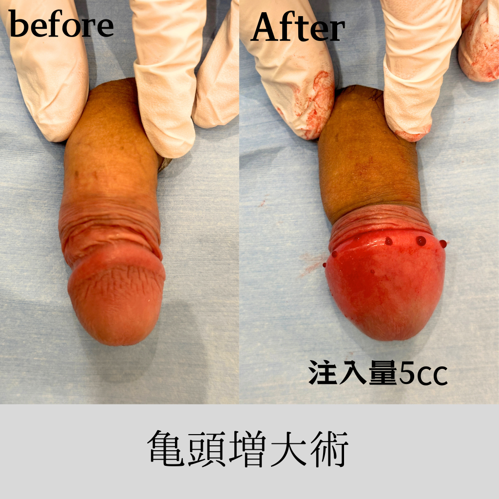 症例］ 20代 亀頭増大術 「亀頭増大の巨塔：硬さと自信を求めて」 - プロクリニック 銀座一丁目駅近くの美容クリニック