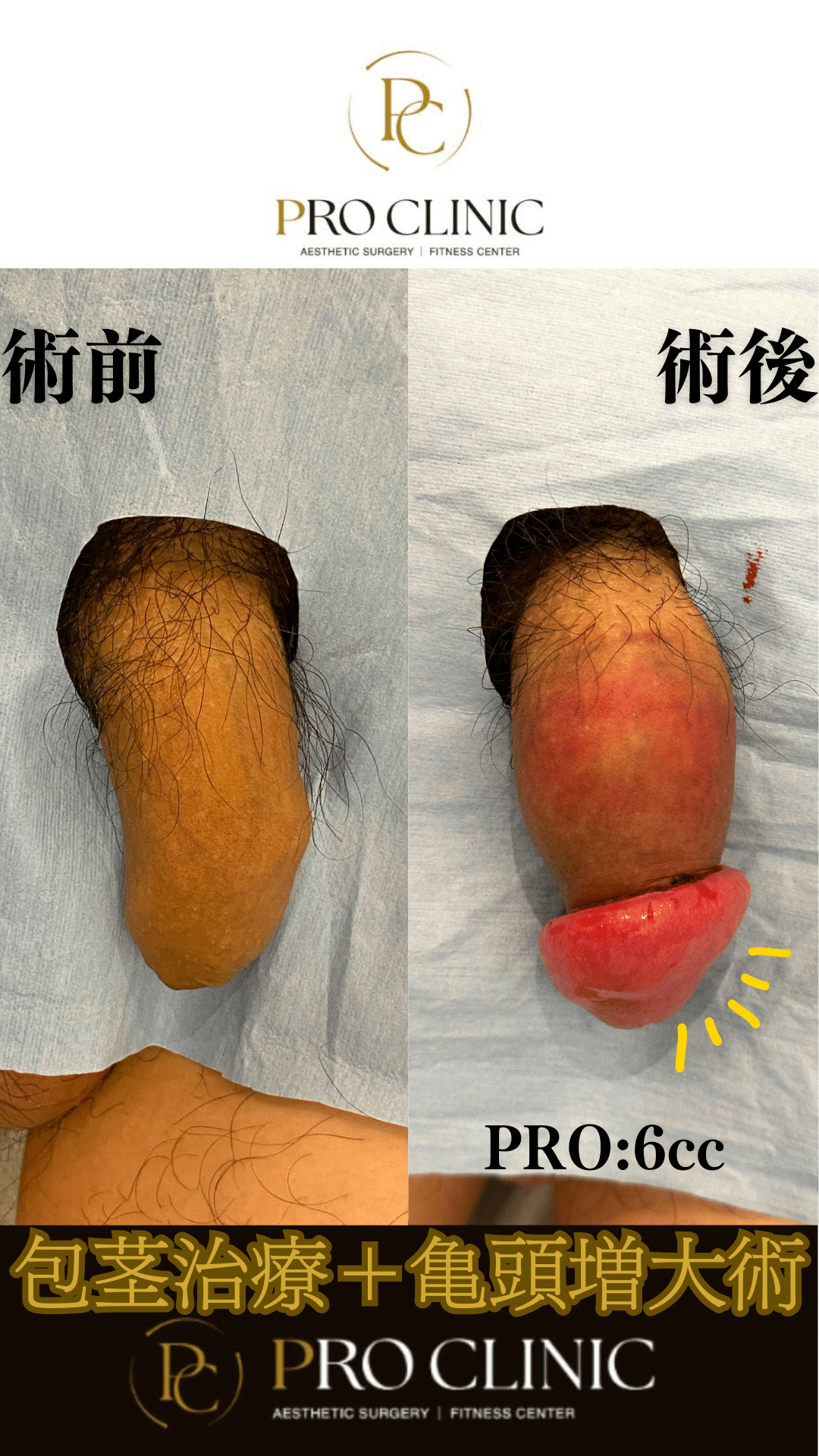 [症例] 20代 包茎治療＋亀頭増大術「日常生活での不便からの解放〜カントン包茎から逆転ホームラン」 - プロクリニック 銀座一丁目駅近くの ...