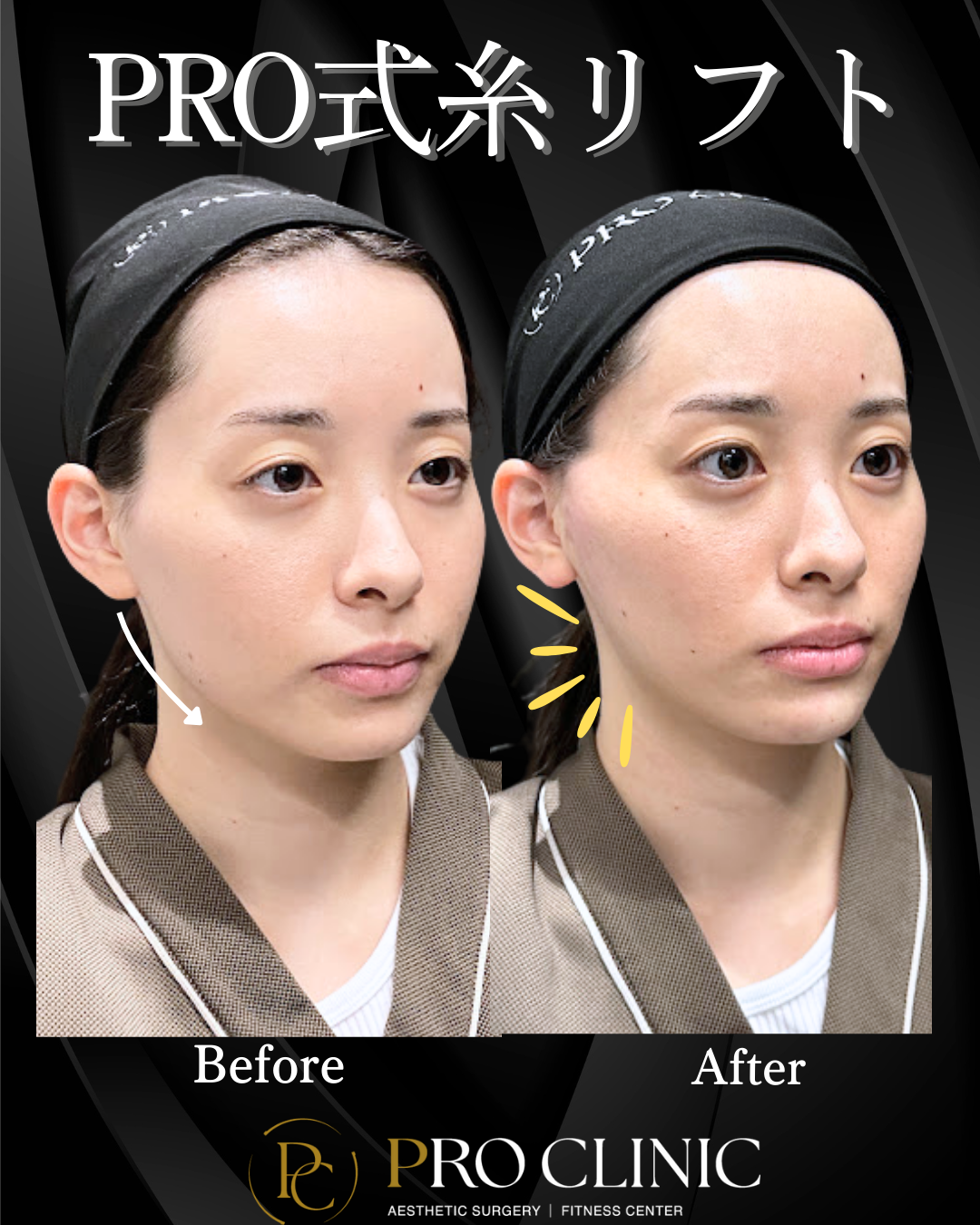 糸リフト施術後の輪郭（フェイスラインのもたつきが修正された）