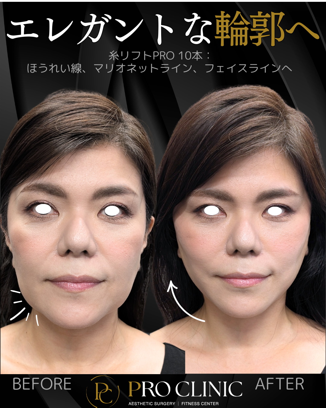 糸リフトPRO 10本による症例写真。ほうれい線・マリオネットライン・フェイスラインを改善し、若々しくエレガントな輪郭に変化した女性のビフォーアフター。
