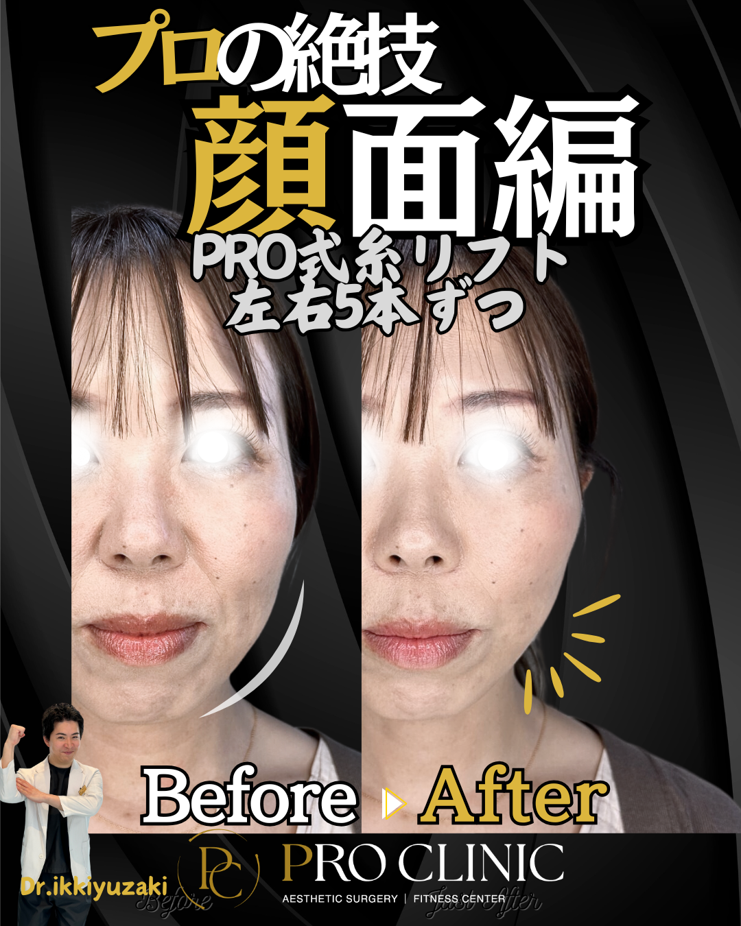 糸リフト施術前の横顔（フェイスラインのもたつきが見られる）