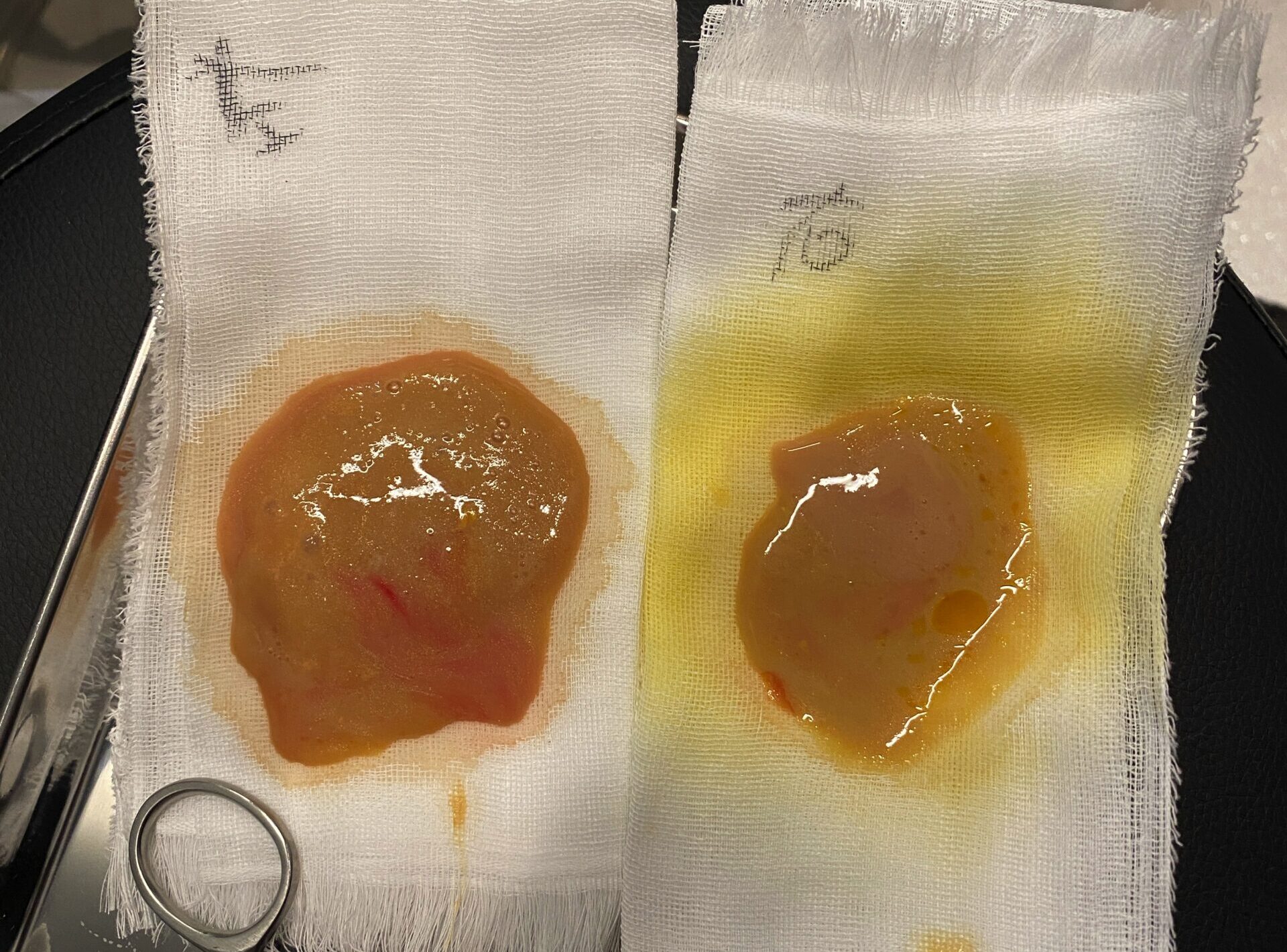 非吸収性フィラーの合併症（除去困難、遅発性炎症、肉芽腫、バイオフィルム感染）をまとめて示した医療イラスト。